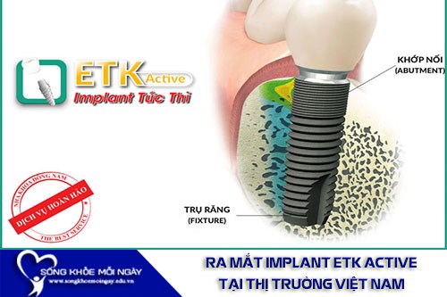 Ưu Đãi 20% Cấy Ghép Implant ETK Active