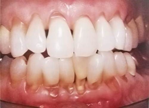 Nguyên nhân hình thành khuyết cổ răng