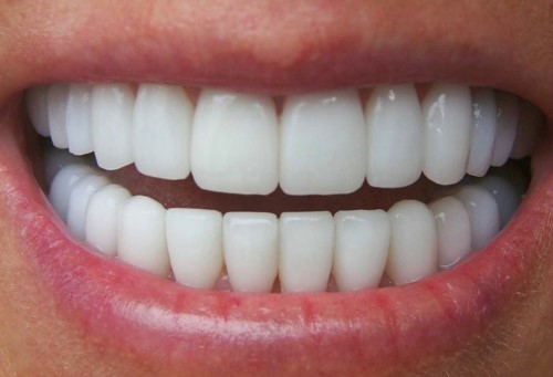 Khắc phục khuyết cổ răng bằng cách bọc răng sứ