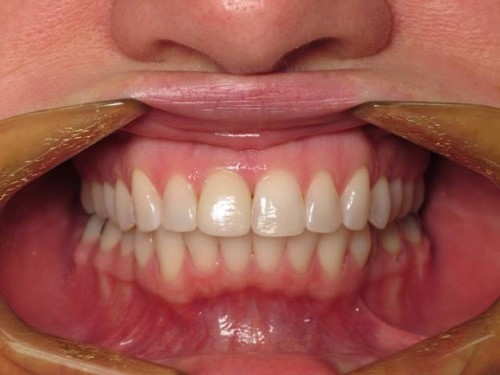 trồng răng giả như răng thật bằng kỷ thuật trồng răng implant