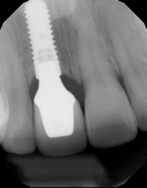 trồng răng giả như răng thật bằng kỷ thuật trồng răng implant 4