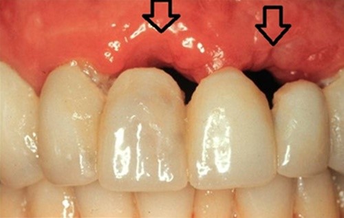 trồng răng với cấu răng sứ và cái kết