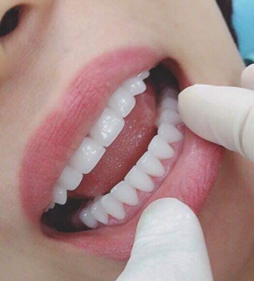 Kinh nghiệm dành cho những ai có ý định Trồng Răng Implant