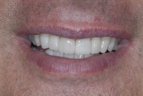 Có Hay Không - Răng Implant là BỘ RĂNG THỨ 3 của con người