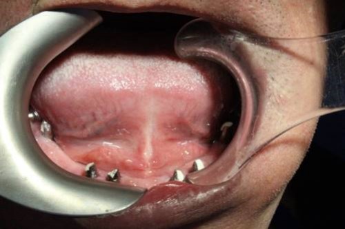 Nếu trồng Implant ngay từ đầu thì có thể giữ được mấy cái răng thật